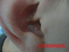 牛皮癣治疗的病例