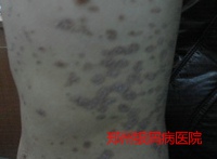 牛皮癣治疗的病例