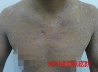 牛皮癣治疗的病例
