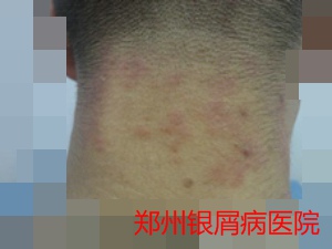 牛皮癣治疗图