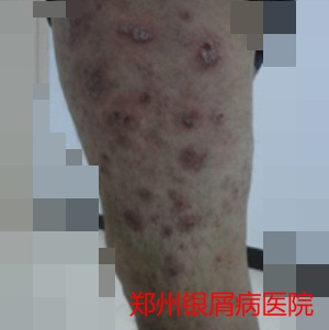 牛皮癣治疗图