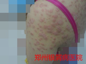 牛皮癣治疗图