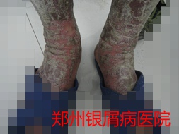银屑病治疗图片