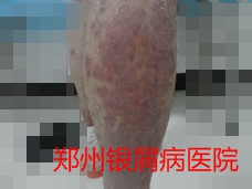 银屑病治疗图片