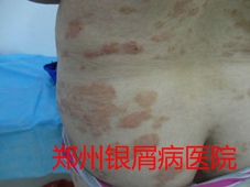 银屑病治疗图片