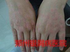银屑病治疗图片