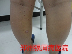 牛皮癣治疗图片