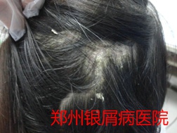牛皮癣治疗图片