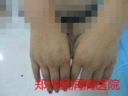 牛皮癣治疗图片