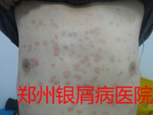 郑州牛皮癣医院牛皮癣治疗图片
