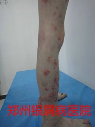 郑州牛皮癣医院牛皮癣治疗图片