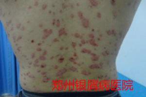 郑州牛皮癣医院牛皮癣治疗图片