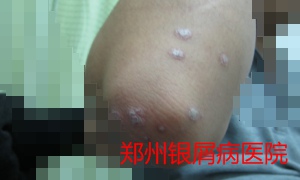 郑州牛皮癣医院治疗牛皮癣图片
