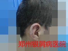 郑州牛皮癣医院治疗牛皮癣图片