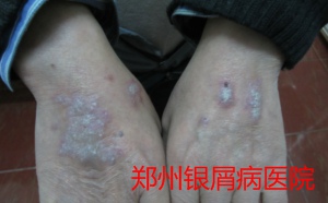 郑州牛皮癣医院治疗牛皮癣图片