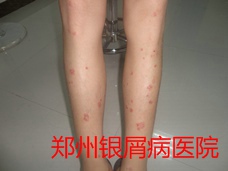 郑州牛皮癣医院牛皮癣治疗图片