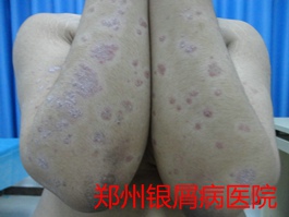 郑州牛皮癣医院牛皮癣治疗图片