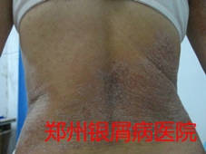 郑州牛皮癣医院治疗牛皮癣图片