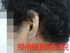 郑州牛皮癣医院治疗牛皮癣图片