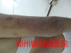 郑州牛皮癣医院治疗牛皮癣图片
