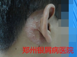 郑州牛皮癣医院牛皮癣治疗图片