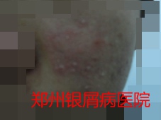 郑州牛皮癣医院牛皮癣治疗图片