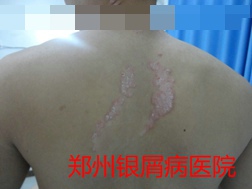 郑州牛皮癣医院牛皮癣治疗图片