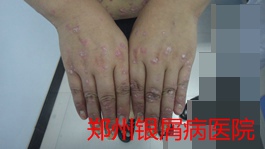 郑州牛皮癣医院治疗牛皮癣图片