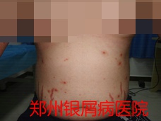 郑州牛皮癣医院治疗牛皮癣图片