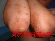 郑州牛皮癣医院治疗牛皮癣图片