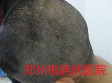 郑州牛皮癣医院治疗牛皮癣图片
