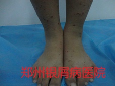 郑州牛皮癣医院治疗牛皮癣图片