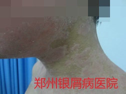 郑州牛皮癣医院治疗牛皮癣图片