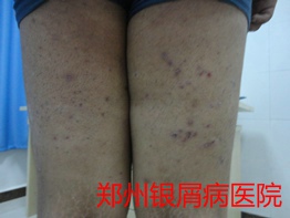 郑州牛皮癣医院治疗牛皮癣图片