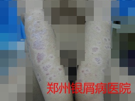 郑州牛皮癣医院治疗牛皮癣图片