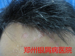 郑州牛皮癣医院治疗牛皮癣图片
