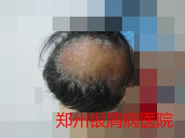 郑州牛皮癣医院治疗牛皮癣图片