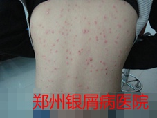 郑州牛皮癣医院治疗牛皮癣图片
