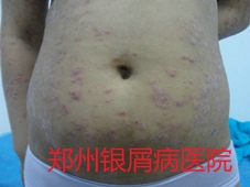 郑州牛皮癣医院牛皮癣治疗图片