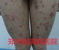郑州牛皮癣医院牛皮癣治疗图片