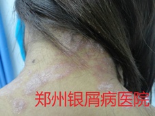 郑州牛皮癣医院牛皮癣治疗图片