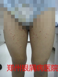 郑州牛皮癣医院治疗牛皮癣图片