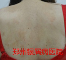郑州牛皮癣医院治疗牛皮癣图片