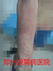 郑州牛皮癣医院治疗牛皮癣图片