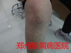 郑州牛皮癣医院治疗牛皮癣图片
