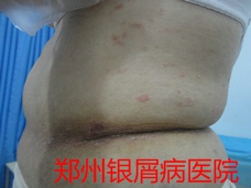 郑州牛皮癣医院治疗牛皮癣图片