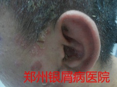 郑州牛皮癣医院治疗牛皮癣图片