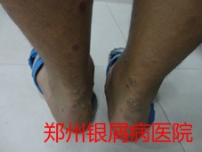 郑州牛皮癣医院治疗牛皮癣图片