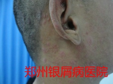 郑州牛皮癣医院治疗牛皮癣图片