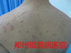 郑州牛皮癣医院治疗牛皮癣图片